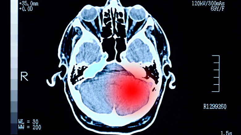 Imagen de daño cerebral